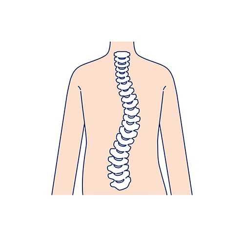 イラスト：脊柱側弯