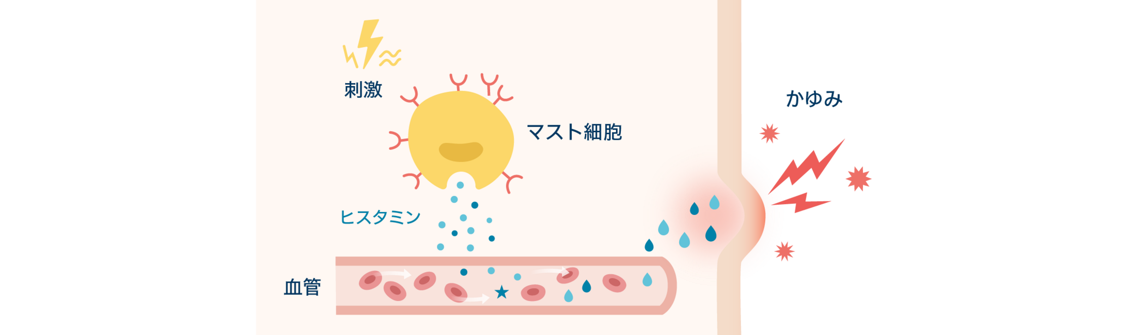 イラスト：「じんましん」が起こるメカニズム