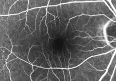 フルオレセイン蛍光眼底造影による正常な眼の画像