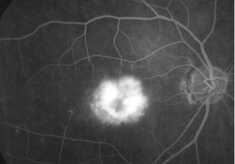 フルオレセイン蛍光眼底造影による滲出型加齢黄斑(かれいおうはん)変性の画像