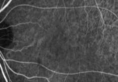 インドシアニン蛍光眼底造影による正常な眼の画像