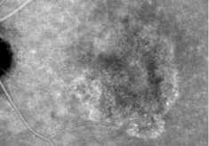 インドシアニン蛍光眼底造影による滲出型加齢黄斑(かれいおうはん)変性の画像