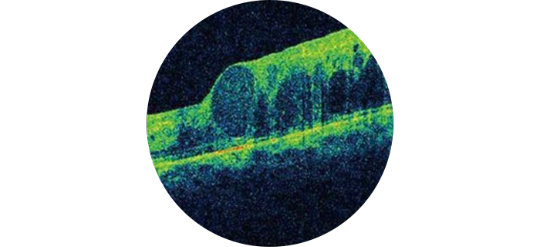 イメージ：糖尿病黄斑浮腫とは？