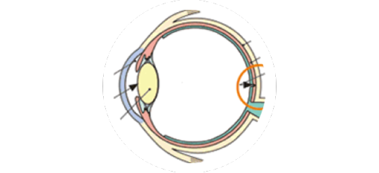 加齢黄斑変性の種類