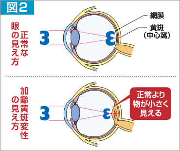 図2 加齢黄斑変性の見え方は、正常より物が小さく見えます。