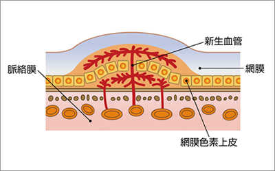 イメージ：脈絡膜、新生血管、網膜色素上皮、網膜の位置を示したイラスト