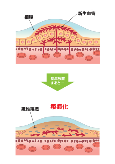 よくある質問 | 加齢黄斑変性 | 網膜ドットコム | ノバルティス
