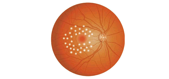 格子状凝固(図)