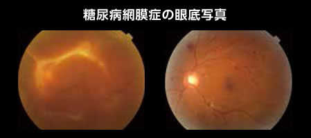 糖尿病網膜症の眼底写真