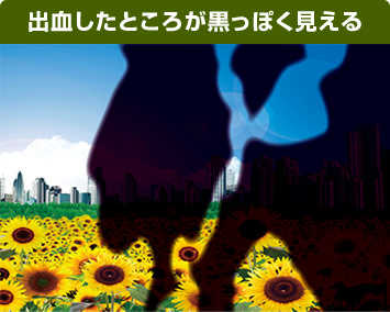 出血したところが黒っぽく見える