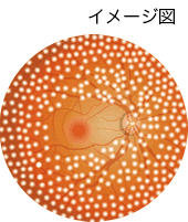 汎網膜光凝固の画像