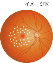 格子状光凝固の画像