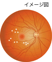 局所光凝固の画像