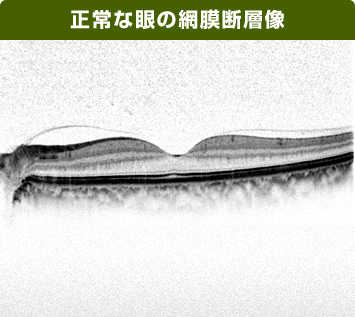 正常な眼の網膜断層像の画像