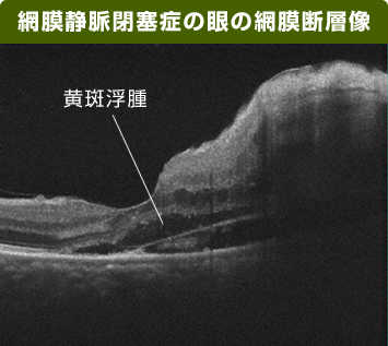 網膜静脈分枝閉塞症の眼の網膜断層像の画像
