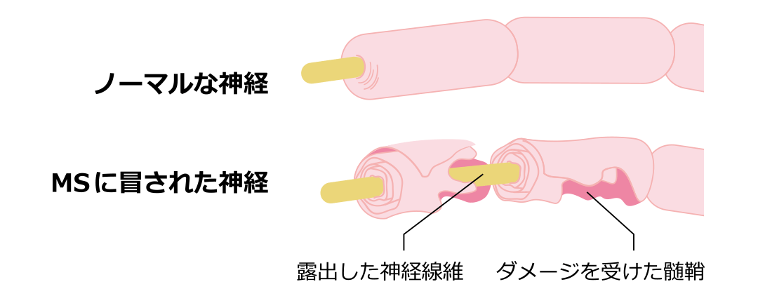 イメージ:多発性硬化症 (MS)とは