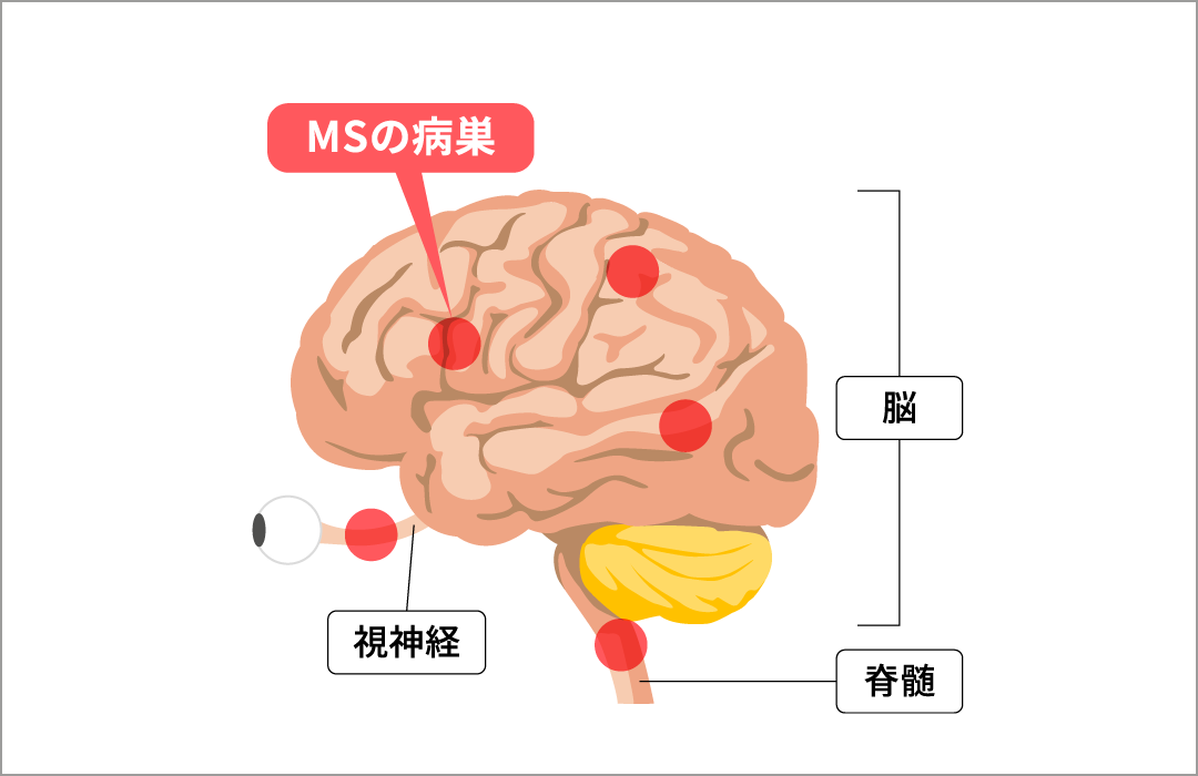 MSで病巣のできる場所