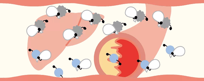 高コレステロール血症とは