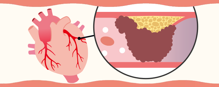 急性冠症候群（急性心筋梗塞／不安定狭心症）とは