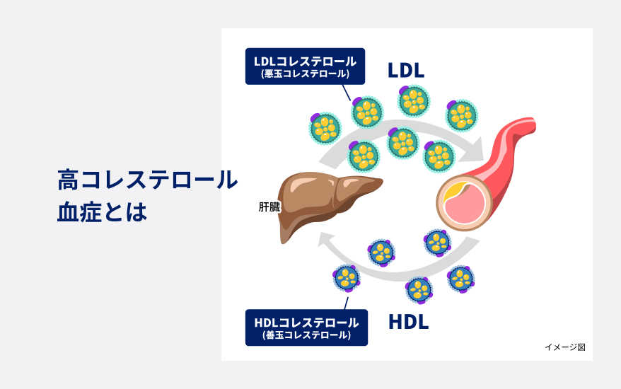 サムネイル：高コレステロール血症とは