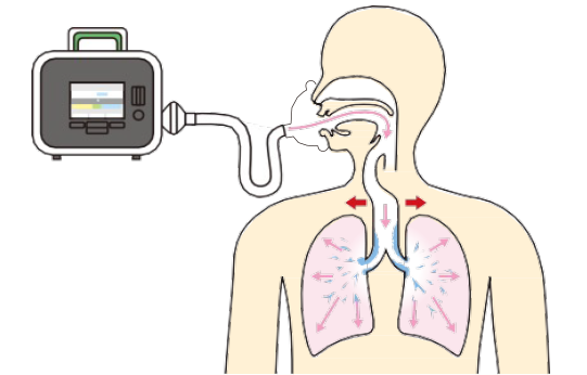 イメージ：呼吸障害への対処