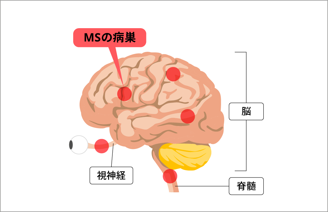 MSで病巣のできる場所